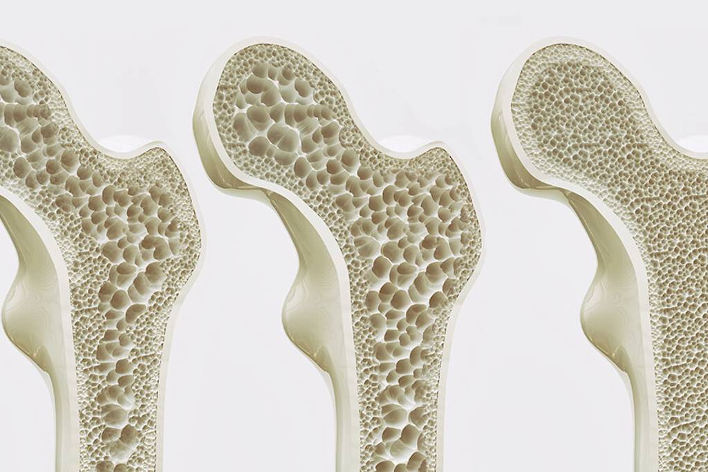 Cos'è l'osteoporosi perché colpisce anziani e donne anziane